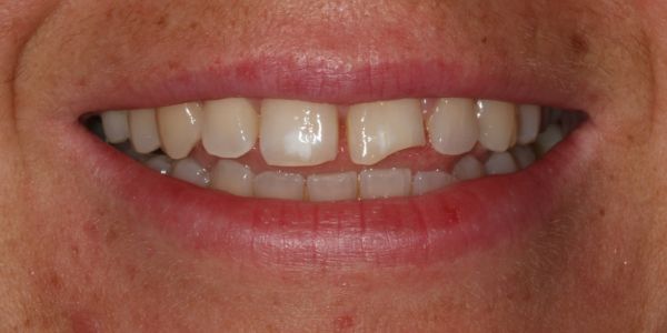 Before composite bonding treatment in Blackburn 