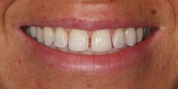 After composite bonding treatment in Blackburn 