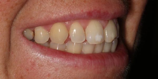 Before composite bonding treatment in Blackburn 