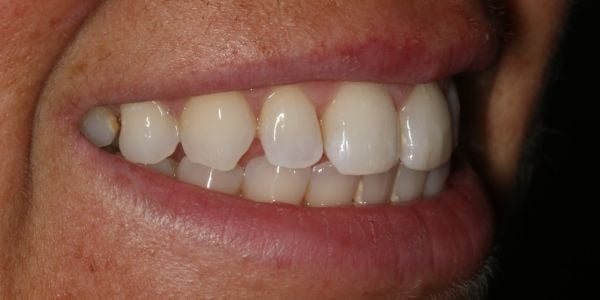 After composite bonding treatment in Blackburn 