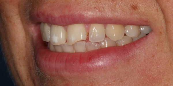 Before composite bonding treatment in Blackburn 