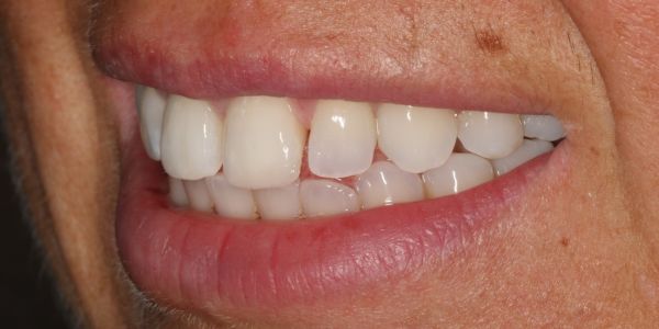 After composite bonding treatment in Blackburn 